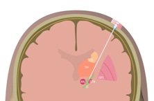 Animated guide tube inplant image