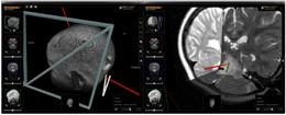 neuroinspire™ biopsy planning