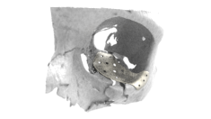LaserImplant Orbital floor implant