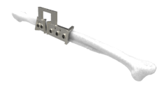 LaserImplant Fibula cutting guide