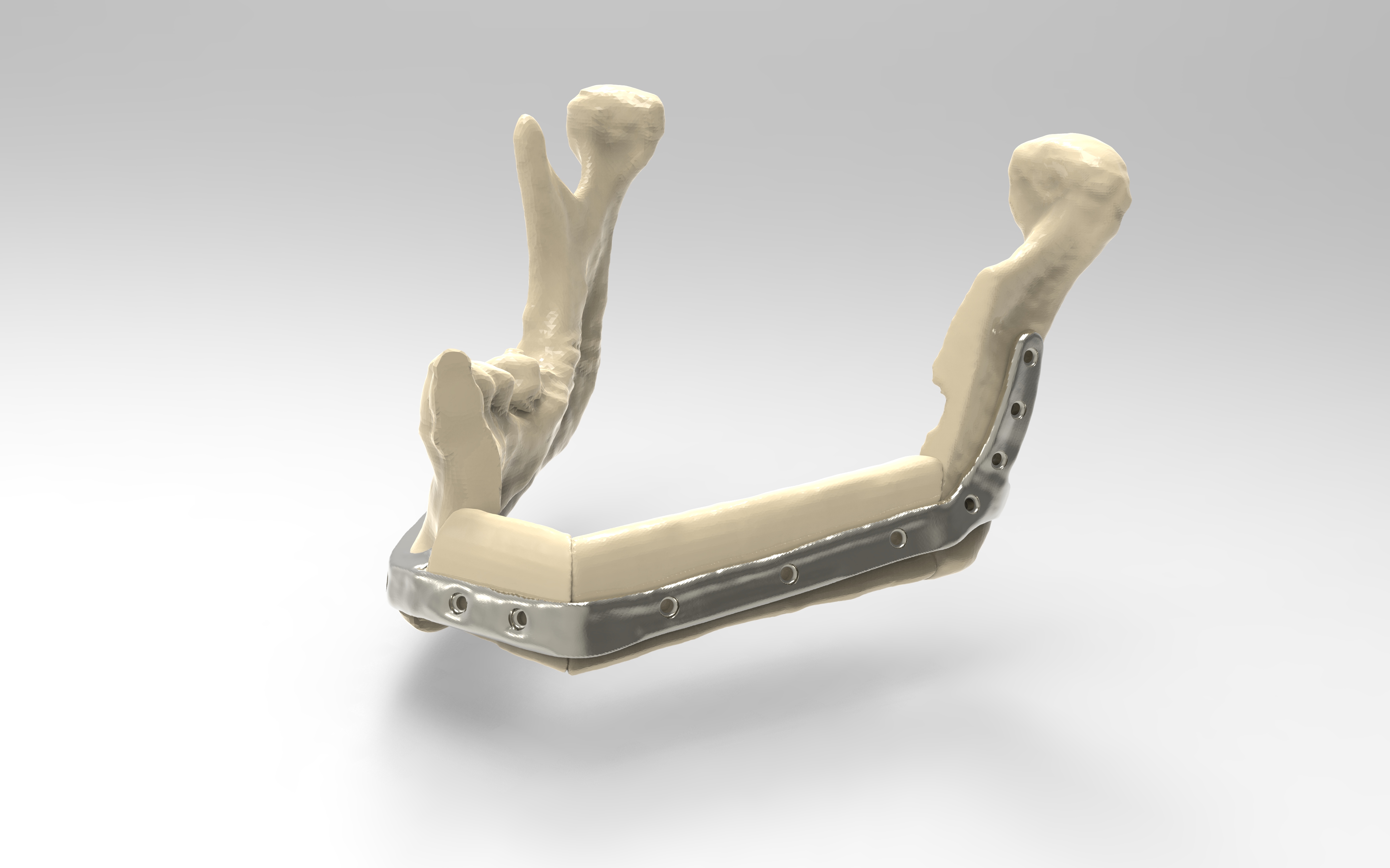 Jaw with fibula sections retained by mandibular plate