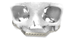 LaserImplant Maxilla implant