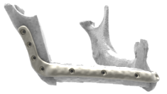 LaserImplant Jaw plate
