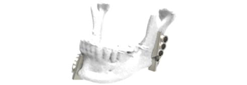LaserImplant™ mandibular cutting and drilling guides